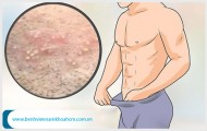 Cảnh giác nổi mụn ở vùng kín nam