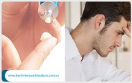 Thuốc Bôi Viêm Bao Quy Đầu Nên Dùng Loại Nào Là Tốt?