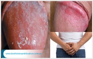 Đau đầu với hiện tượng nấm dương vật ở nam giới