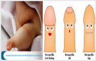 Thông tin cần biết khi điều trị hẹp bao quy đầu ở trẻ