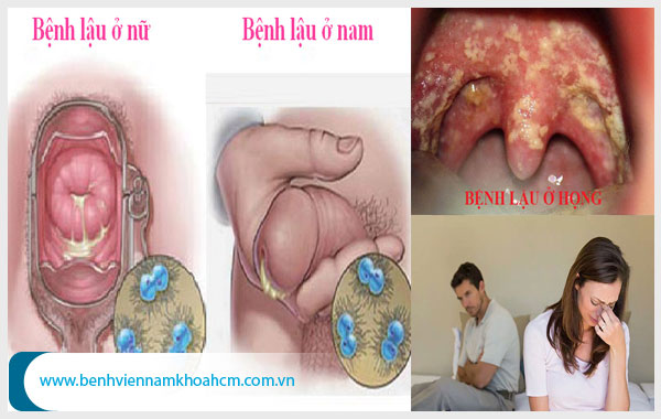 Biểu hiện của bệnh trĩ lậu 