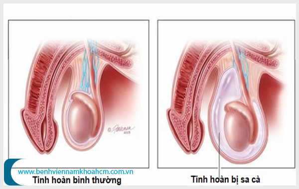 Có nhiều nguyên nhân gây bệnh sa tinh hoàn