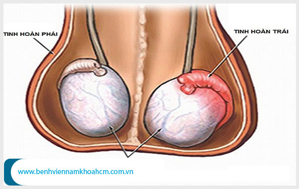 Đau tinh hoàn trái là bệnh gì? Có nguy hiểm không?