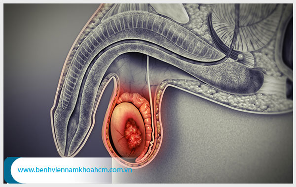 Đau tinh hoàn trái là bệnh gì? Có nguy hiểm không?