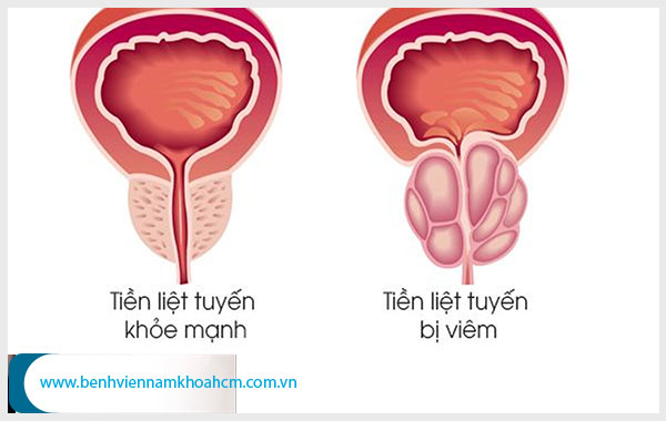 Những bệnh nam khoa thường gặp mà nam giới không nên chủ quan